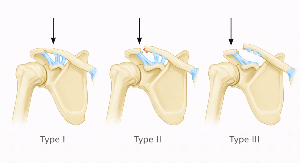 What is an AC Joint Injury?