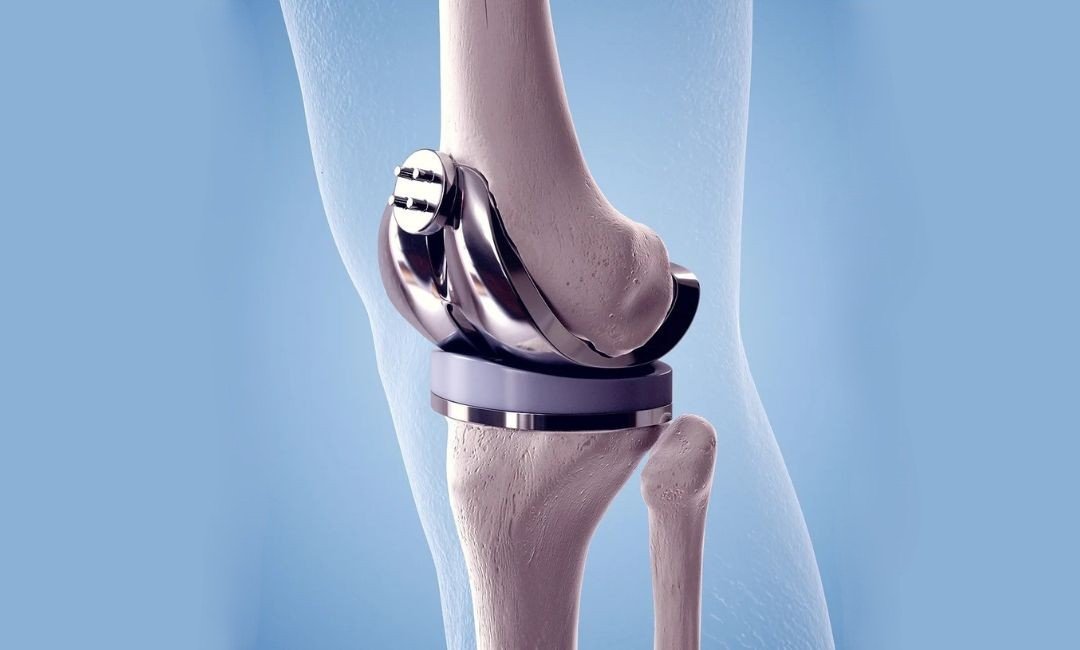Knee Replacement Surgery