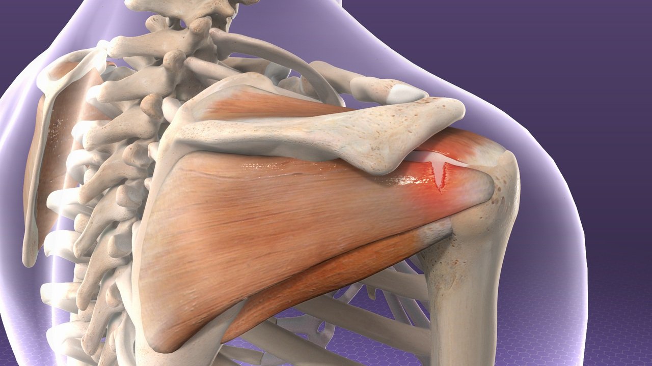 Rotator Cuff Injury
